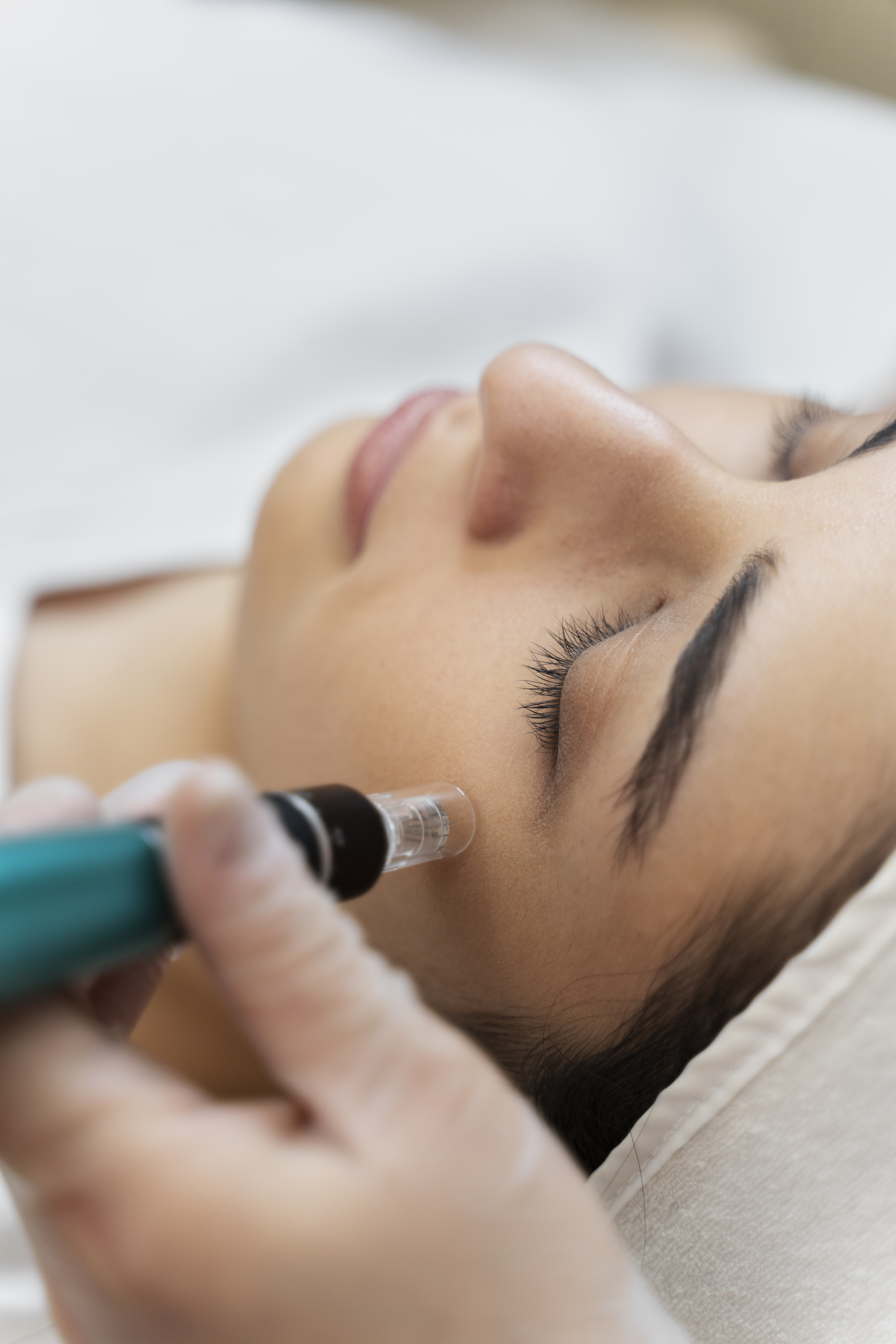 Bio Needling